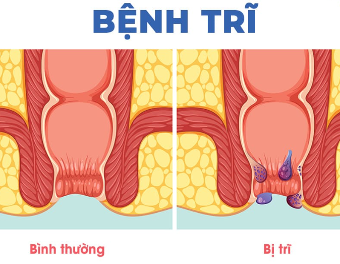 Bệnh trĩ có lây khi ngồi chung ghế không? Giải đáp chi tiết