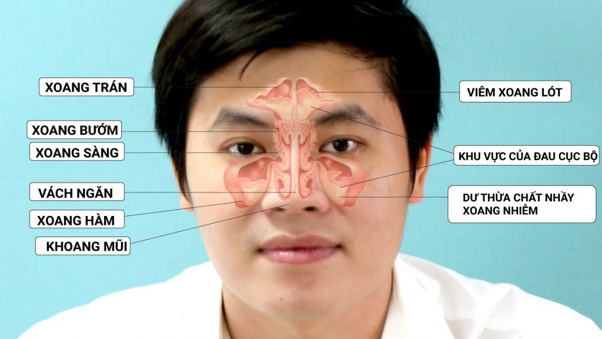 Các thảo dược tiêu viêm thông mũi cho người bị viêm xoang cấpmạn tính