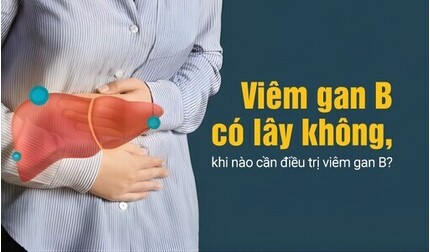 Viêm gan B có lây không, khi nào cần điều trị viêm gan B?