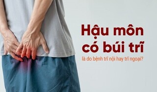Hậu môn có búi trĩ là do bệnh trĩ nội hay trĩ ngoại?