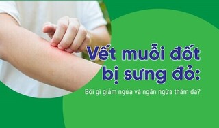 Vết muỗi đốt bị sưng đỏ: Bôi gì giảm ngứa và ngăn ngừa thâm da?