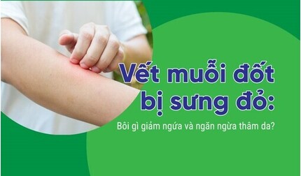Vết muỗi đốt bị sưng đỏ: Bôi gì giảm ngứa và ngăn ngừa thâm da?