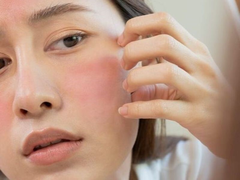 Hướng dẫn cách rửa mặt cho da nhạy cảm, dễ bị nổi mẩn