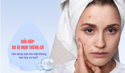 Giải đáp Da bị mụn trứng cá nên dùng sữa rửa mặt không bọt hay có bọt