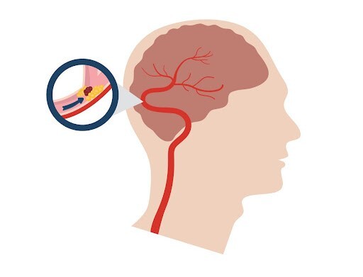 Muốn khỏe, thì đừng quên hoạt huyết, tăng cường lưu thông máu