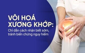 Vôi hoá xương khớp: Chỉ dẫn cách nhận biết sớm, tránh biến chứng