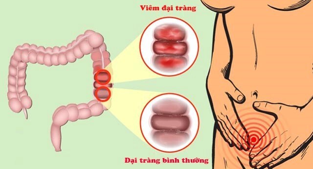 Giải đáp: Viêm đại tràng có tiến triển thành ung thư không?