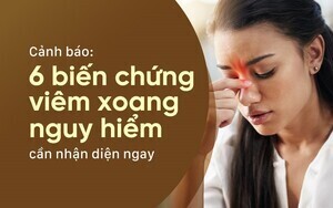 Cảnh báo: 6 biến chứng viêm xoang nguy hiểm cần nhận diện ngay