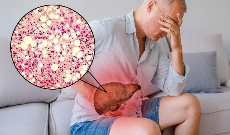 Giải đáp chi tiết: Men gan cao nên làm gì?