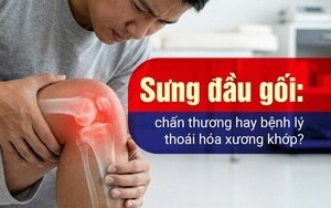 Sưng đầu gối: chấn thương hay bệnh lý thoái hóa xương khớp?