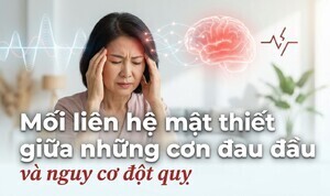 Mối liên hệ mật thiết giữa những cơn đau đầu và nguy cơ đột quỵ