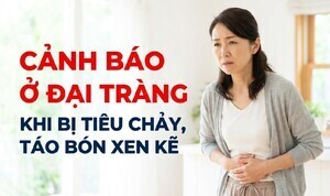 Cảnh báo ở đại tràng khi bị tiêu chảy, táo bón xen kẽ