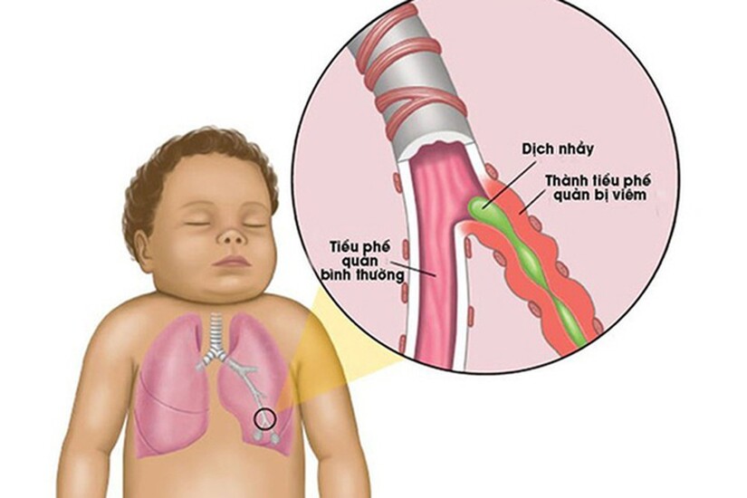 Mách mẹ cách chọn siro bổ phế "đúng chuẩn" chuyên gia