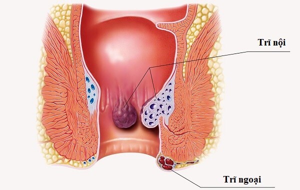 Trĩ dai dẳng vì quên nguyên tắc kiềng 3 chân khi điều trị bệnh trĩ