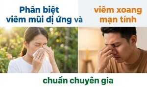 Phân biệt viêm mũi dị ứng và viêm xoang mạn tính chuẩn chuyên gia