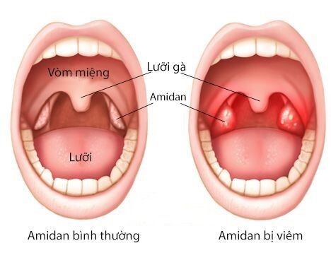 Dung dịch Xịt Họng Nhất Nhất Kid hỗ trợ giảm ho do viêm amidan