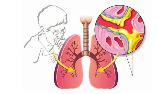 Giải đáp: siro bổ phế giúp cắt cơn ho hay giúp ho dễ hơn?