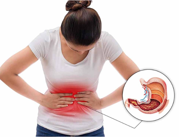 Dành cho người bệnh dạ dày: 5 tiêu chí chọn thuốc dạ dày thảo dược