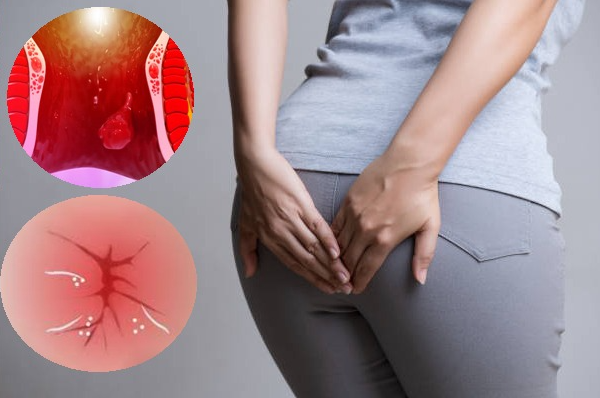 5 thảo dược tự nhiên giúp đẩy lùi tình trạng trĩ gây ngứa hậu môn