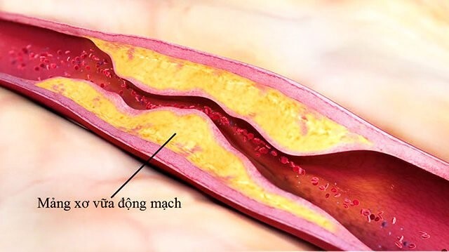 Chủ động phòng tránh xơ vữa động mạch qua từng bữa ăn