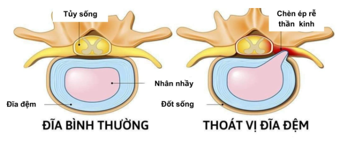 Đau cột sống không cúi được: dấu hiệu của thoát vị đĩa đệm