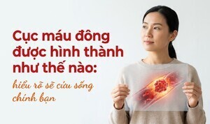 Cục máu đông được hình thành như thế nào: hiểu rõ sẽ cứu sống bạn