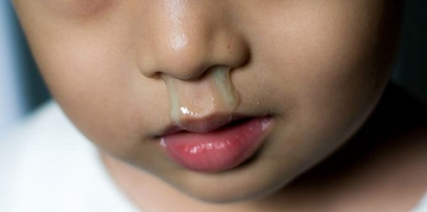 Sổ mũi xanh ở trẻ: giải đáp nguyên nhân và hướng dẫn làm sạch mũi