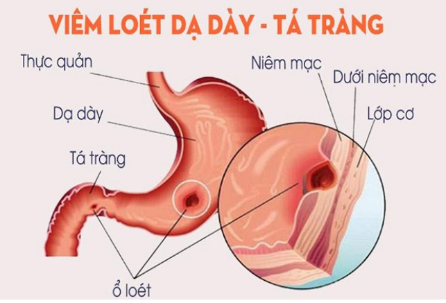 Thuốc Dạ Dày Nhất Nhất: hướng dẫn cách dùng, liệu trình