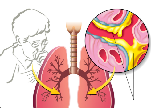 Giải mã ho có đờm dai dẳng, uống thuốc ho mãi không khỏi
