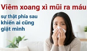 Viêm xoang xì mũi ra máu - sự thật phía sau khiến ai cũng giật mình