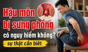 Hậu môn bị sưng phồng có nguy hiểm không? sự thật cần biết