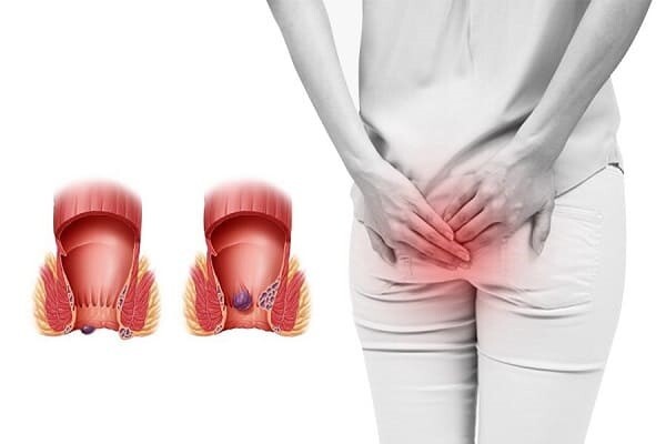 Tìm hiểu thành phần bài thuốc trĩ giảm đau, co búi trĩ, ngừa tái phát