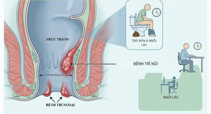 Tìm hiểu thành phần bài thuốc trĩ giảm đau, co búi trĩ, ngừa tái phát