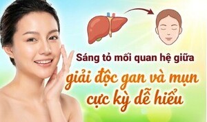 Sáng tỏ mối quan hệ giữa giải độc gan và mụn cực kỳ dễ hiểu