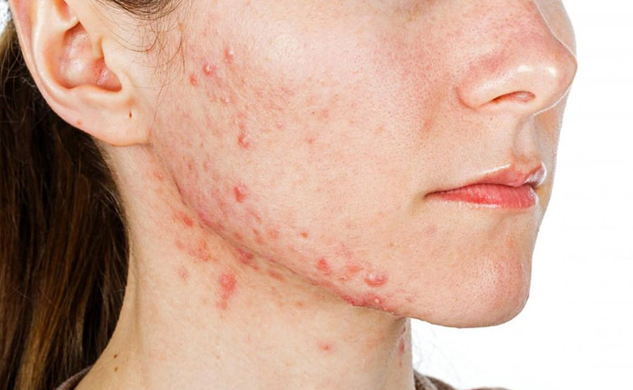 Sáng tỏ mối quan hệ giữa giải độc gan và mụn cực kỳ dễ hiểu