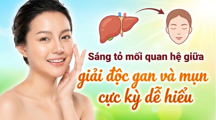 Sáng tỏ mối quan hệ giữa giải độc gan và mụn cực kỳ dễ hiểu