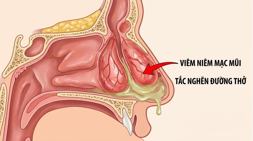 Hay bị nghẹt mũi 1 bên không thở được: lý do ít ai ngờ!
