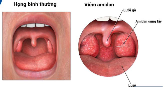 Nguyên nhân ít ai ngờ khiến trẻ bị viêm amidan tái đi tái lại