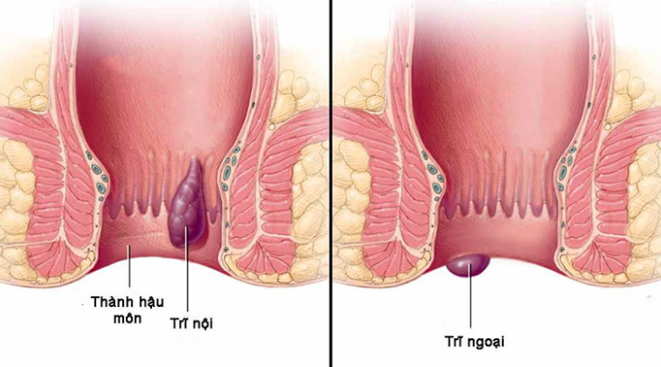 Búi trĩ sa ra ngoài có co lại được không? giải đáp chi tiết