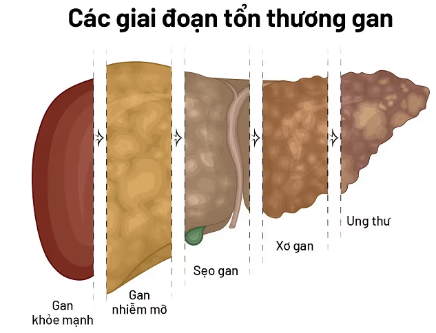 Tại sao không uống rượu bia vẫn mắc gan nhiễm mỡ và men gan cao?