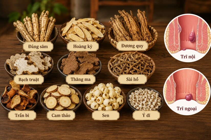 Phân biệt trĩ nội và trĩ ngoại: bệnh trĩ nào dễ điều trị hơn?
