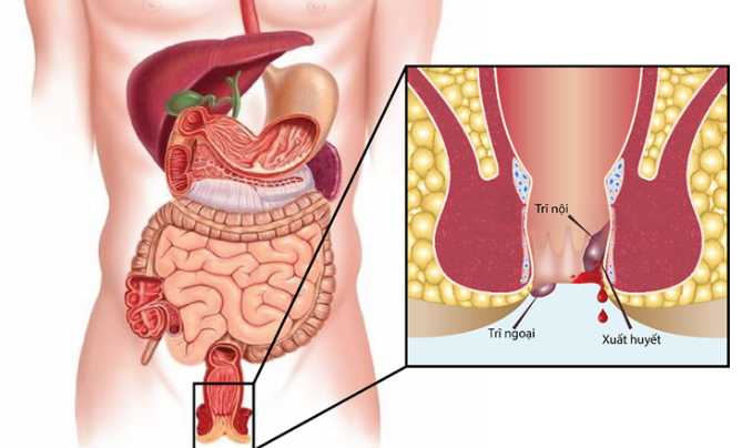 Phân biệt trĩ nội và trĩ ngoại: bệnh trĩ nào dễ điều trị hơn?