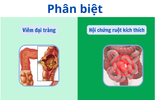 Ăn gì cũng đau bụng, đi ngoài liên tục: do viêm đại tràng hay co thắt
