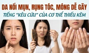 Da nổi mụn, rụng tóc, móng dễ gãy tiếng kêu cứu của cơ thể thiếu kẽm
