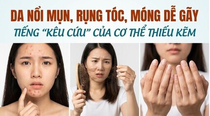 Da nổi mụn, rụng tóc, móng dễ gãy tiếng kêu cứu của cơ thể thiếu kẽm