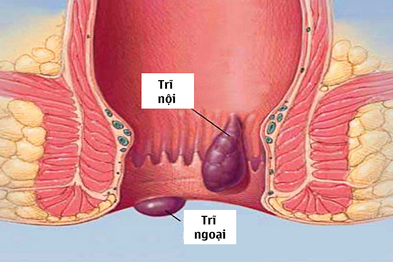 So sánh biện pháp điều trị bệnh trĩ thuốc uống, thuốc bôi, phẫu thuật