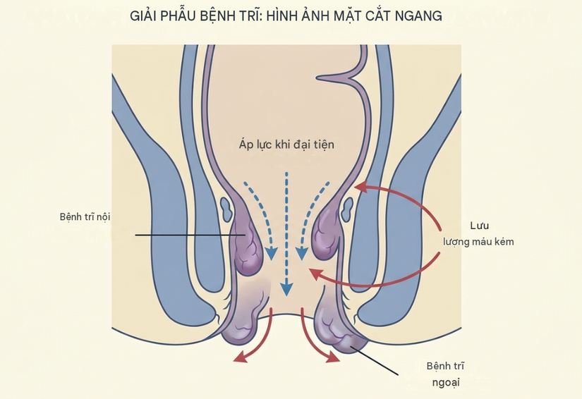 Mẹo xoa dịu cảm giác đau rát, sưng tấy do bệnh trĩ ngay tại nhà