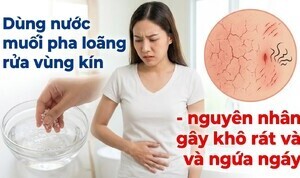Dùng nước muối pha loãng rửa vùng kín - gây khô rát và ngứa ngáy
