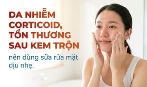 Da nhiễm corticoid, tổn thương sau kem trộn: dùng sữa rửa mặt dịu nhẹ