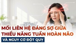 Mối liên hệ đáng sợ giữa thiểu năng tuần hoàn não và nguy cơ đột quỵ
